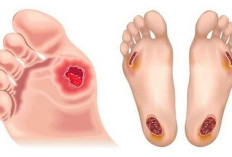 Luka Menganga, Bahaya Mengintai Diabetes Basah dan Risiko Infeksi yang Mematikan