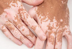 Cara Mengatasi Vitiligo Bercak Putih di Kulit yang Kehilangan Pigmen Warna 