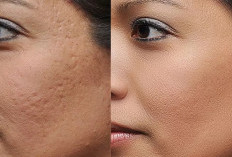 Tekstur Kulit Membuat Tampilan Makeup Kurang Maksimal, 7 Cara Menghilangkan Gradakan di Wajah Pakai Skincare