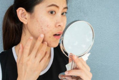 Cara Mengatasi Jerawat dengan Skincare yang Tepat  ﻿